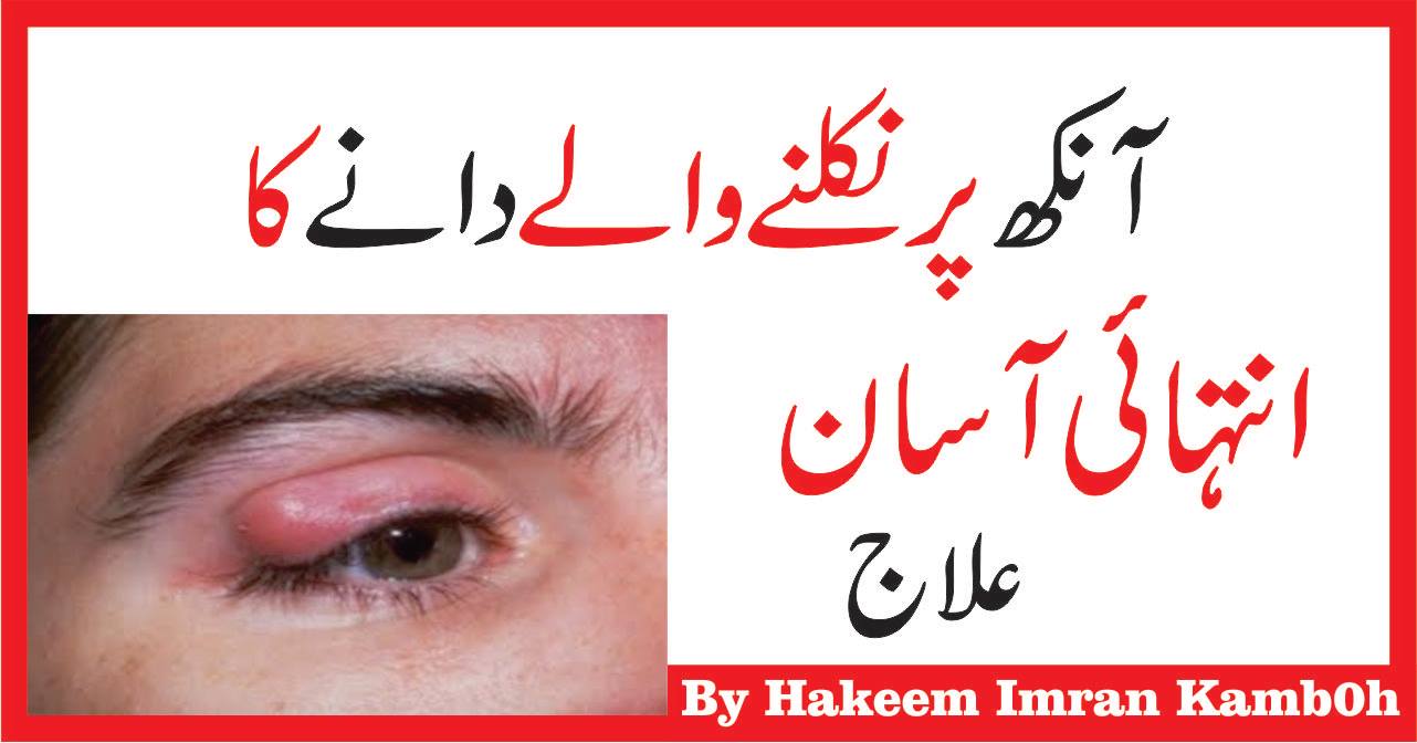 Aankhon Ki Sujan Ka Ilaj Tips for Eye Swelling in Urdu Hindi